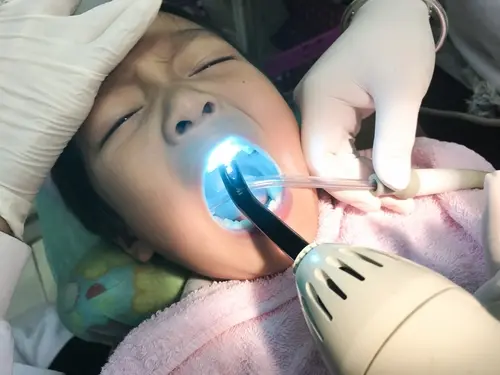 Dental Sealants - Kid Grins