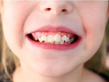 Reasons a child needs a tooth extraction - At Kid Grins they will explain why Reasons a child needs a tooth extraction - At Kid Grins they will explain why