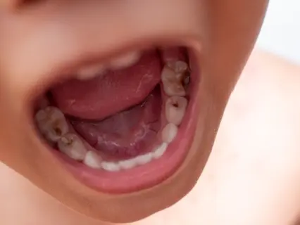Why Tooth-Colored Fillings Are Great For Kids - Kid Grins Explains Why Why Tooth-Colored Fillings Are Great For Kids - Kid Grins Explains Why