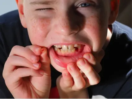 Knocked Out Tooth Row 1 - Kid Grins Is Who You Want to Help.webp Knocked Out Tooth Row 1 - Kid Grins Is Who You Want to Help