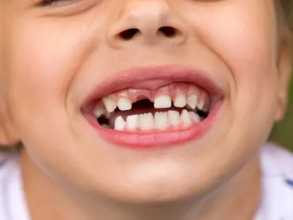What to Do If your Child Knocks Out a Tooth - Kid Grins Are Experts With Knocked Out Teeth What to Do If your Child Knocks Out a Tooth - Kid Grins Are Experts With Knocked Out Teeth