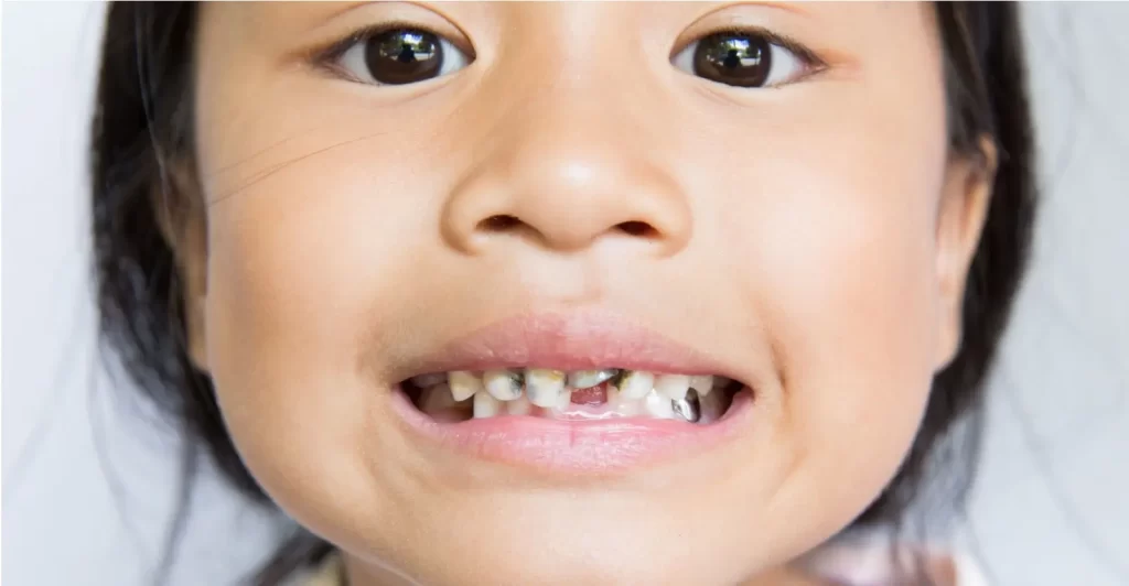 Pediatric Root Canal Treatment for Kids Hero - Kid Grins
