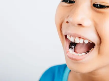 Pediatric Root Canal Treatment for Kids Row 1 - Kid Grins.webp