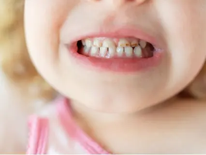 Reasons a Child Needs a Pediatric Root Canal - Kid Grins Will Explain in Detail