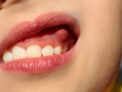 Signs Your Child May Need Pediatric Root Canal Treatment - Kid Grins Can Help