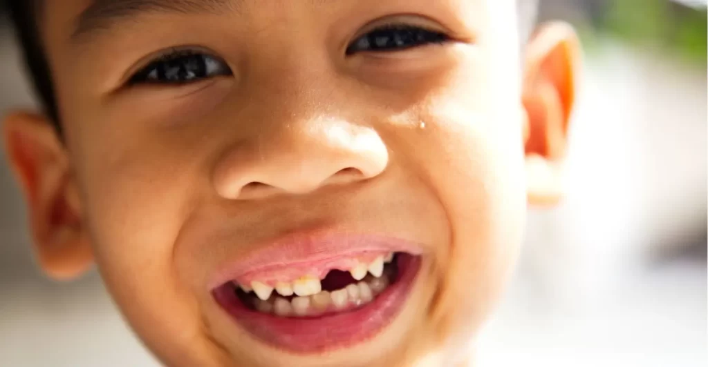 Chipped, Cracked, or Broken Teeth - Kid Grins