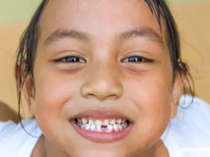 Chipped, Cracked, or Broken Teeth row 1 - Kid Grins 