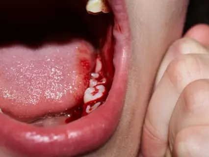 Possible Causes of Abscess or Dental Infection - Kid Grins Possible Causes of Abscess or Dental Infection - Kid Grins