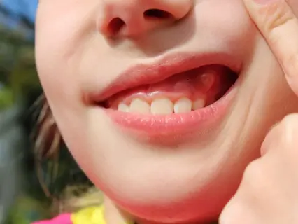 Signs of Abscess or Dental Infection in Your Child - Kid Grins Signs of Abscess or Dental Infection in Your Child - Kid Grins