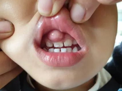 What Is a Dental Abscess - Kid Grins Explains What Is a Dental Abscess - Kid Grins Explains